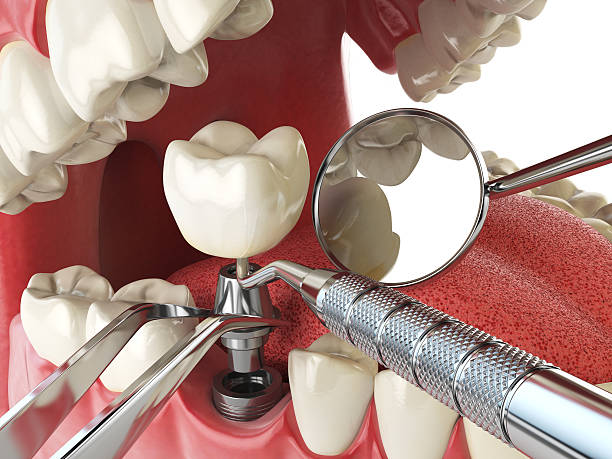 Best Emergency Dental Care for Sports Injuries in New Hyde Park, NY